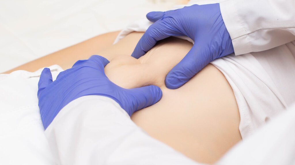 Close-up image of a physician's hands who is wearing purple gloves and performing a check for hernias on a patient's abdomen